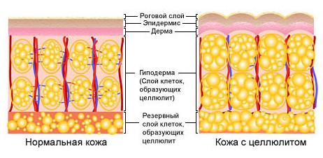 Стадии целлюлита