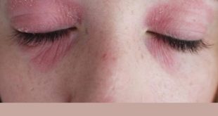 Аллергия на косметику: почему и что делать?