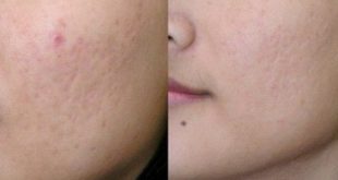 Therapy Acne The easy, fast And Painless Way